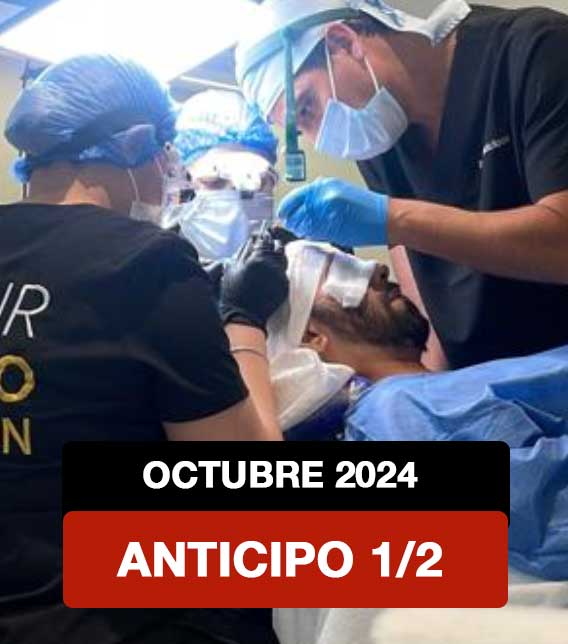 Anticipo Hair Transplant Workshop OCTUBRE 2024